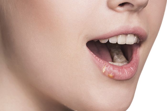 Menjaga Kesehatan Rongga Mulut dan Menghilangkan Plak Gigi dengan Propolis